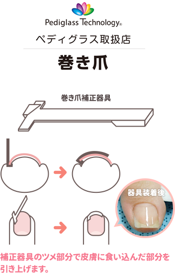 当院の巻き爪矯正はペディグラス・テクノロジーという名の特許技術です。